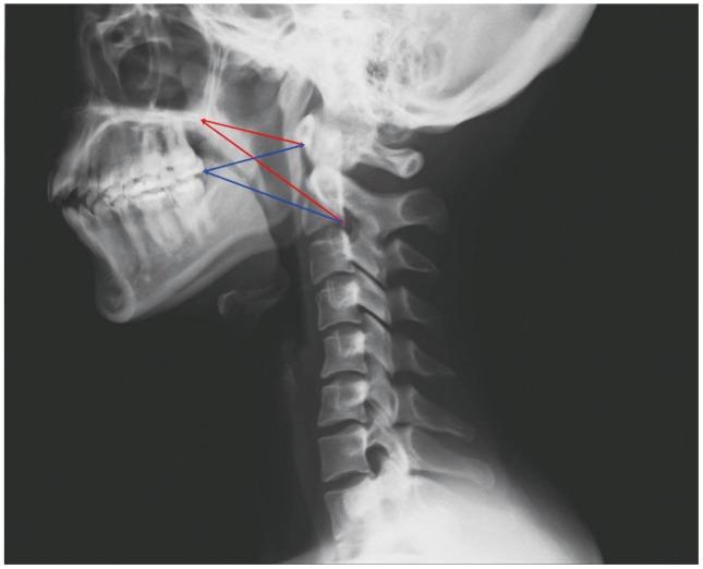 TMJ disorder imaging